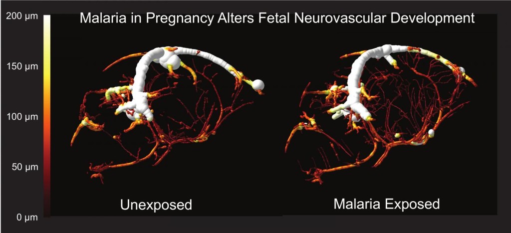 Malaria in pregnancy leads to cognitive defects in offspring - Study