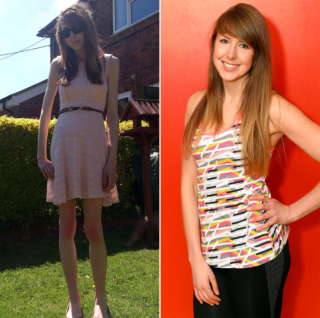 Young Yoman Beats 5years Anorexia Battle To Become A Personal Trainer