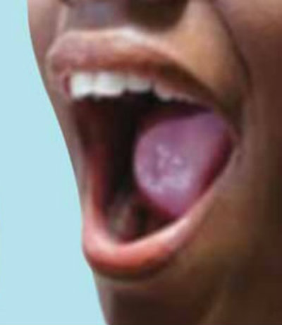 bad breath