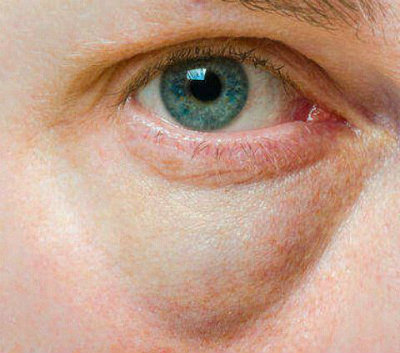 treat puffy eyes