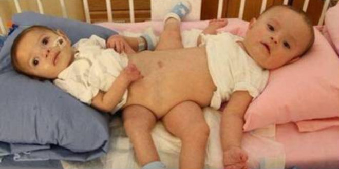 conjoined twins