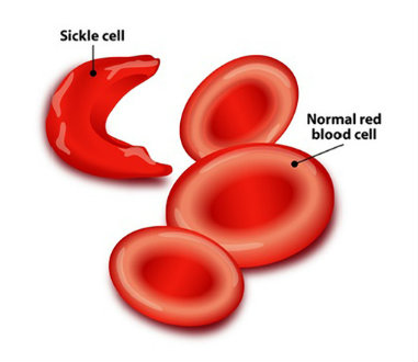 Sickle cell disease