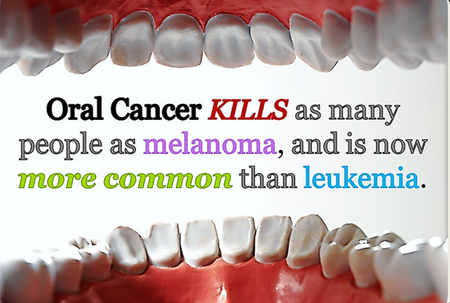 Mouth cancer now the 10th most common cancer in men & 15th in women