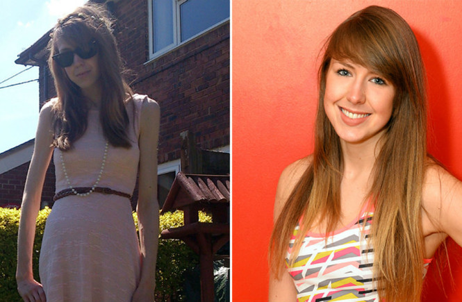 Young Yoman Beats 5years Anorexia Battle To Become A Personal Trainer
