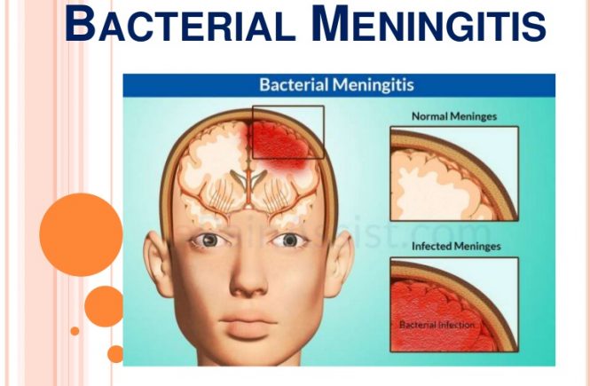 All You Should Know About Bacterial Meningitis - elsieisy blog