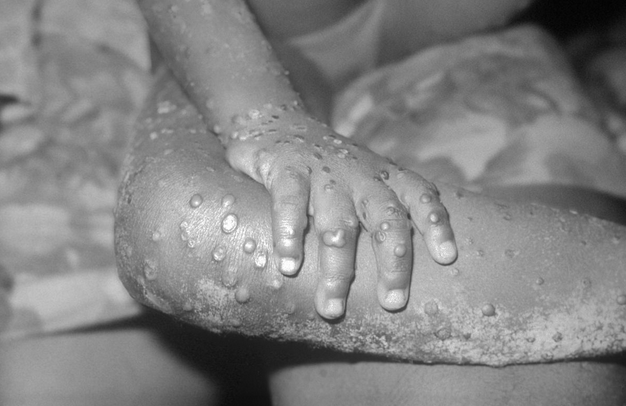 Monkeypox - elsieisy blog