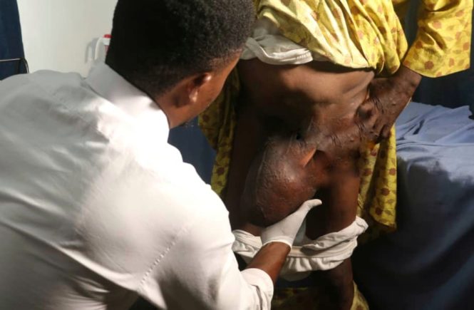 HERNIA PATIENTS GET FREE SURGERY AT SHONOWO HOSPITAL FOUNDATION elsieisy blog