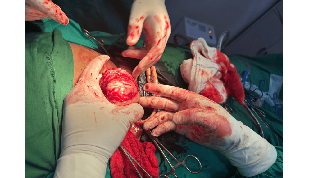 Elsue Godwin undergoing open myomectomy